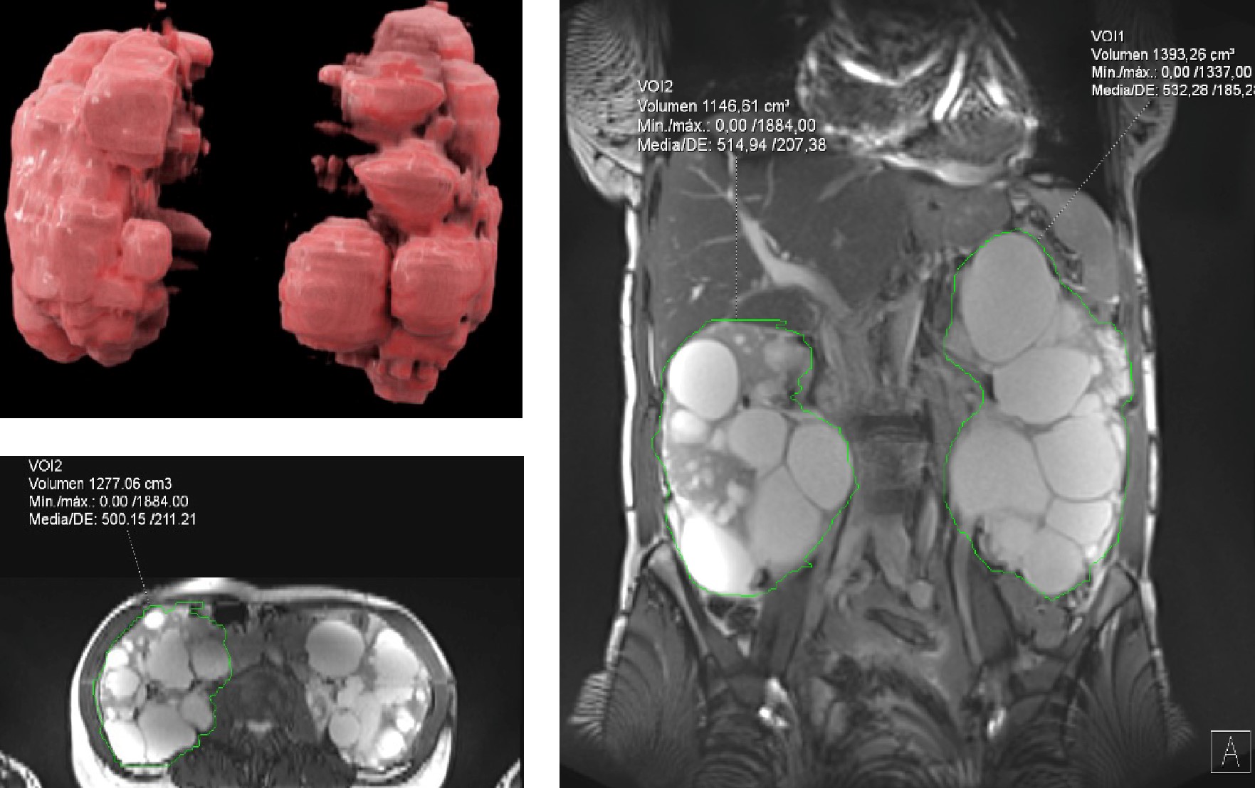 Cálculo mediante segmentación de volumetría renal a través de resonancia magnética con reconstrucción volumétrica 3D en paciente con poliquistosis renal bilateral